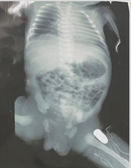 Bebê atingido por tiro ainda dentro do útero da mãe vai passar por cirurgia em Imperatriz